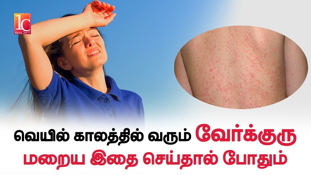 How To Cure Heat Rash