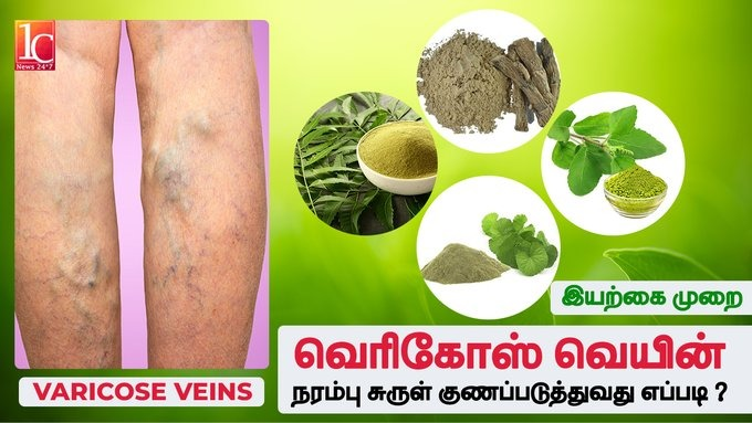 வெரிகோஸ் வெயின் சரியாக அருமையான வைத்தியம் | How To Cure Varicose Vein Using Natural Remedies