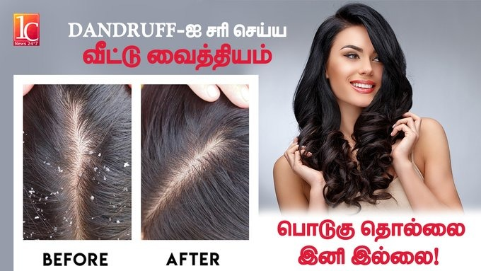 பொடுகு அடியோடு நீங்க வீட்டு வைத்தியம் | How to cure Dandruff | Home Remedies